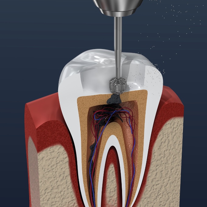 P334 Root Canal Anatomy and Endodontic Access Cavity thumbnail