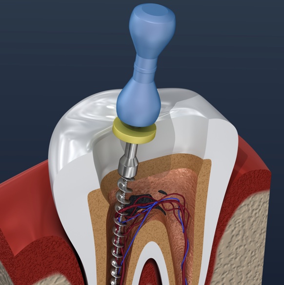 P337 Endodontic Obturation thumbnail