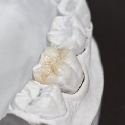 Image representing P542 Tips and Tricks for the Adhesive Cementation of Ceramic Inlays, Onlays, and Veneers