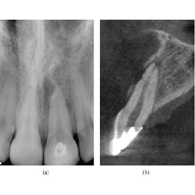 Image representing P570 Use of Cone Beam Computed Tomography in Endodontics