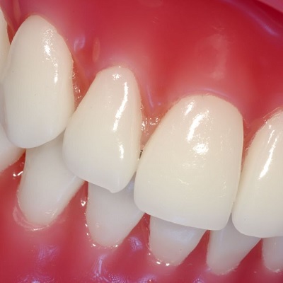 Image representing P669 Gingival Indices: State of Art
