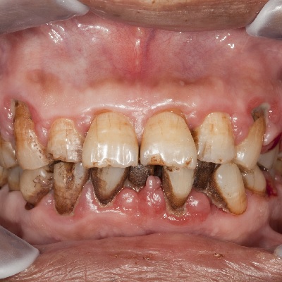 Image representing P705 Basic Oral Care for the Mouth Cancer Patient