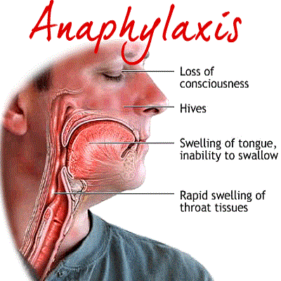 Image representing P006 Anaphylaxis Treatment