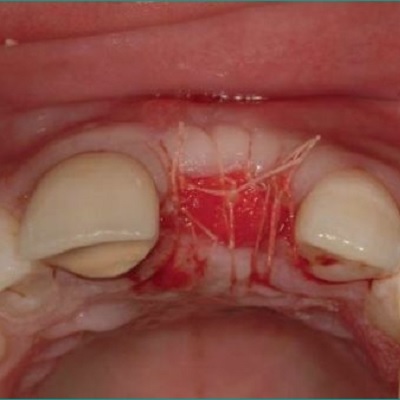 Image representing P149 Management of the Extraction Socket: Site Preservation Prior to Implant Placement