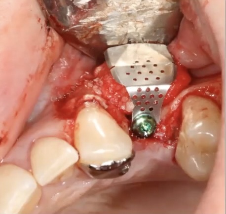 Image representing P173 Predictable Bone Grafting Using Titanium Mesh