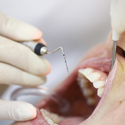 Image representing P251 Periodontal Disease: Conservative Management