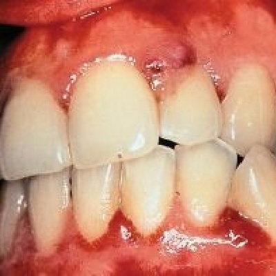 P283 Pregnancy Gingivitis, Periodontitis and its Systemic Effect thumbnail