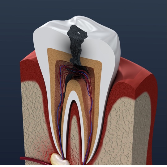 Image representing P330 Endodontic Diagnosis and Treatment Planning