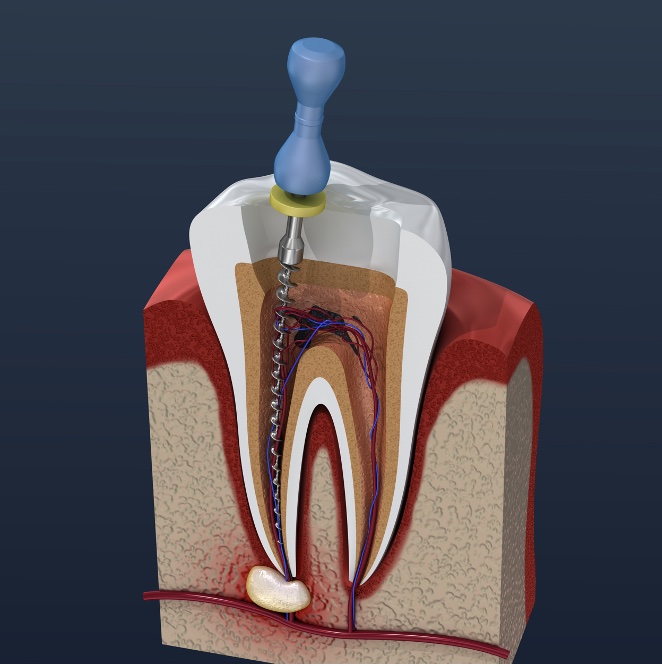 Image representing P335 Working Length and Root Canal Instrumentation