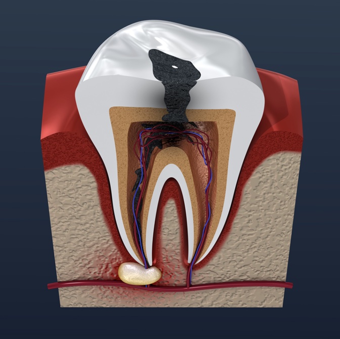 Image representing P331 Pain Control in Endodontics