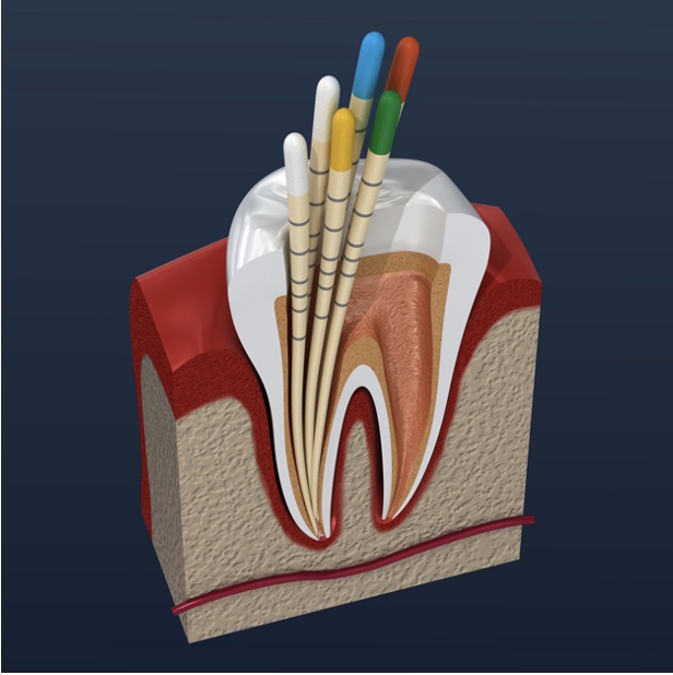 Image representing P338 Post Endodontic Restoration