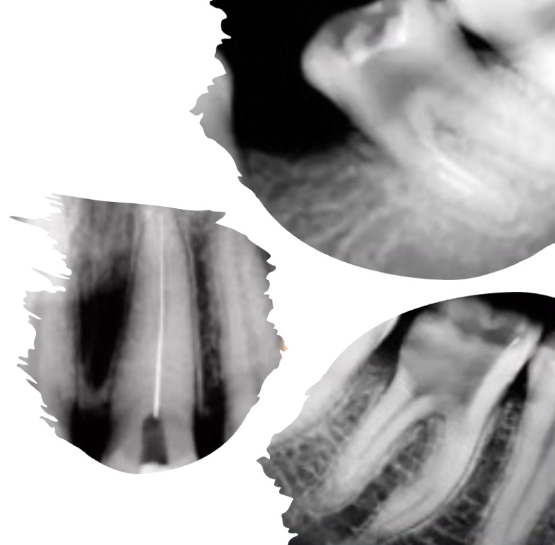 Image representing P339 Management of Iatrogenic Mishaps in Endodontics
