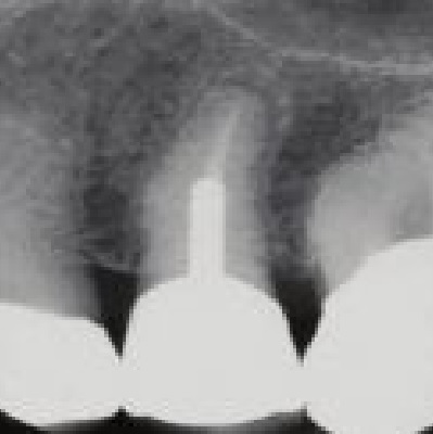 Image representing P616 Restoration of Endodontically Treated Teeth Review and Treatment Recommendations