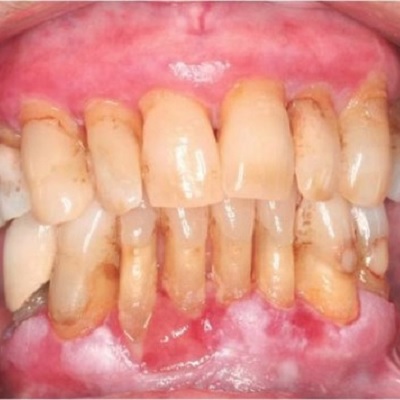 P690 Aetiology of Gingivitis thumbnail