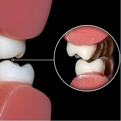 Image representing P015 Understanding the Basic Concepts Of Occlusion
