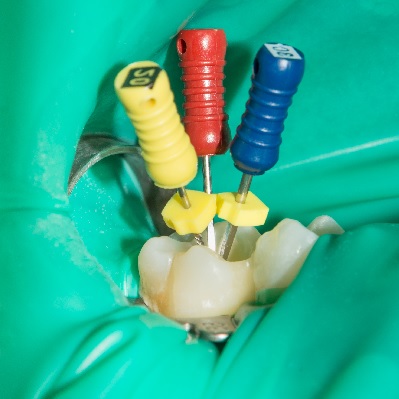 Image representing P061 Isolation in Endodontics