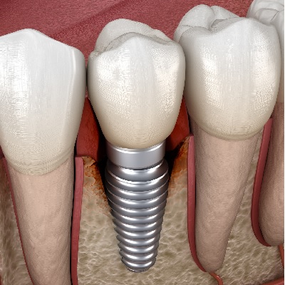 Image representing P165 How Can We Minimise the Risk of Peri-Implant Disease? A Practical Guide For Supporting Implant Patients