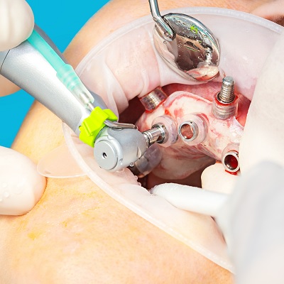 Image representing P167 Guided Surgery: Making Implant Placement Simpler