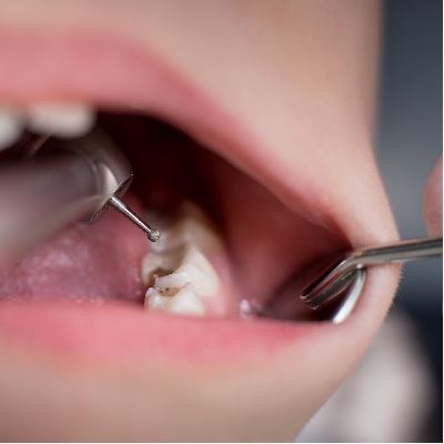 Image representing P185 Treatment Planning for Carious Primary and Permanent Molars