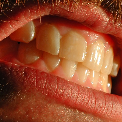 Image representing P188 Management of Worn Anterior Teeth 