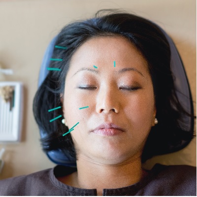 Image representing P208 Dental Acupuncture 
