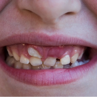 P223 An Update on Managing Ectopic Teeth thumbnail