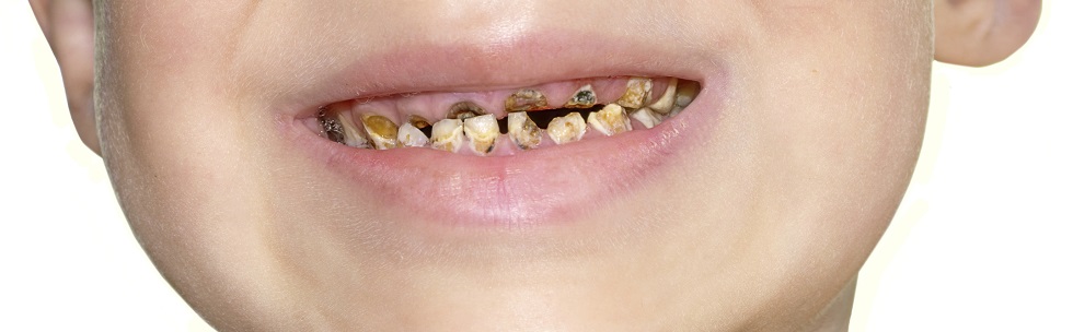 Image representing Children's dental health in some areas of England a matter of 'grave concern'