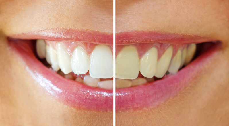 Image representing Tooth whitening and the need for public awareness