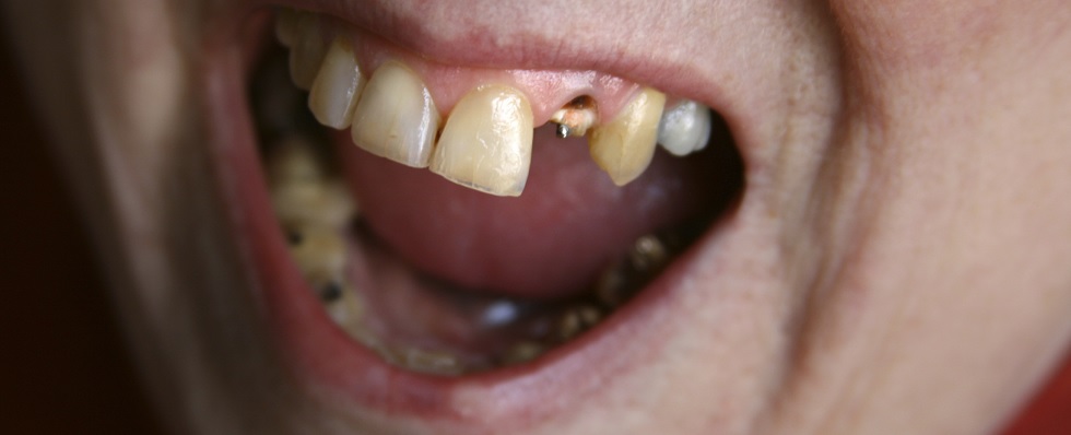 Image representing Dental therapists welcome study that smashes ‘rotten teeth’ stereotype