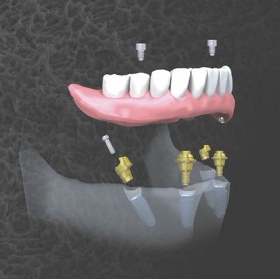 Image representing P361 Immediate Implants in Full Arch Treatments