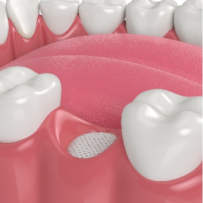 Image representing P173 Predictable Bone Grafting Using Titanium Mesh